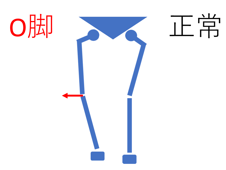 O脚と正常